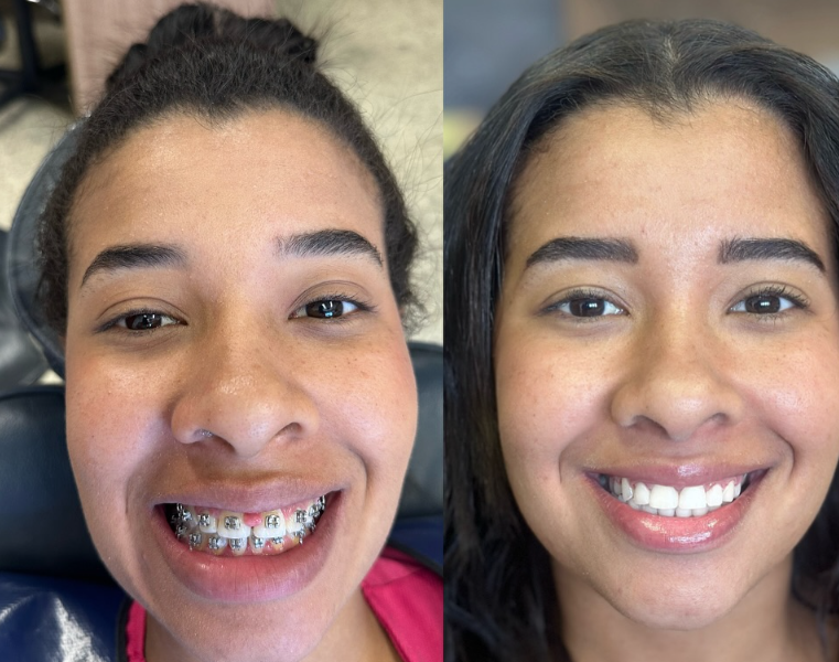 Antes e depois — procedimento 6